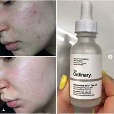 The Ordinary Niacinamide 10% + Zinc 1% – 30ml